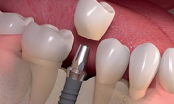 crown and bridge dental clinic Ahmedabad