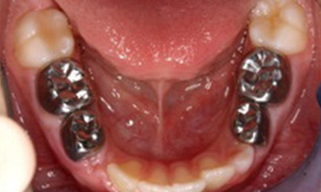 Cavity treatment Ahmedabad