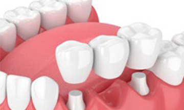 Endodontic treatment Ahmedabad