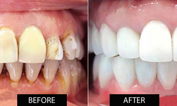 Pediatric dental treatment Ahmedabad