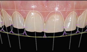 Smile Design Treatment Ahmedabad