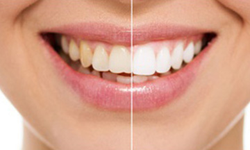 Teeth Whitening Treatment Ahmedabad