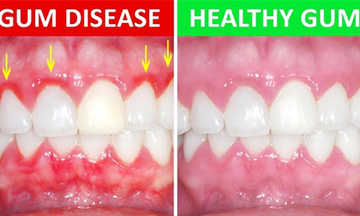 Teeth restoration treatment Ahmedabad
