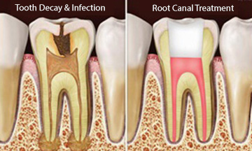 Root Canel Treatment Ahmedabad