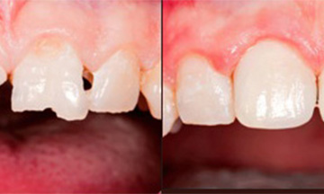 tooth extraction Ahmedabad