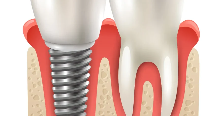Affordable Dental Implants in Ahmedabad
