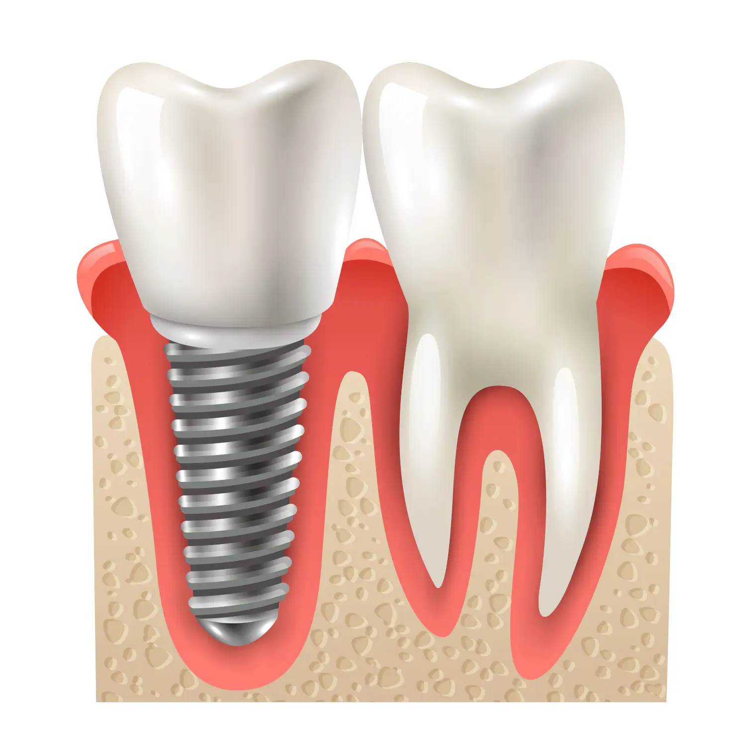 Affordable Dental Implants in Ahmedabad