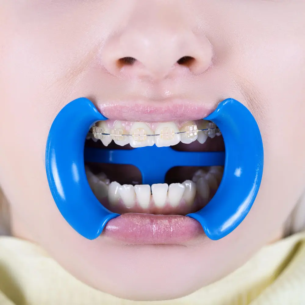 Full Mouth Rehabilitation at Bright Smile Dental Care