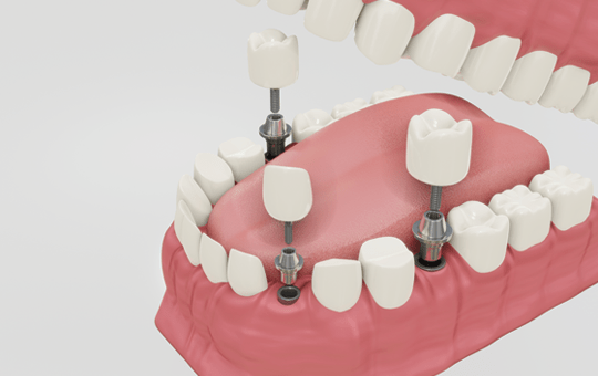 Dental Implant Clinic Ahmedabad
