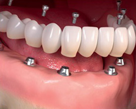 dental crowns and bridges Ahmedabad