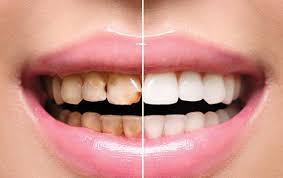 full mouth rehabilitation Ahmedabad