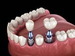 Advanced Dental Implants in Ahmedabad