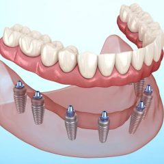 Transform Your Smile with the Best Dental Implant Clinic in Ahmedabad – Bright Smile Dental Care