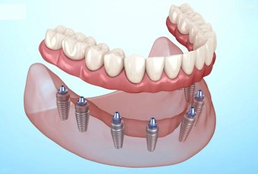 Best Dental Implants Treatment in Ahmedabad