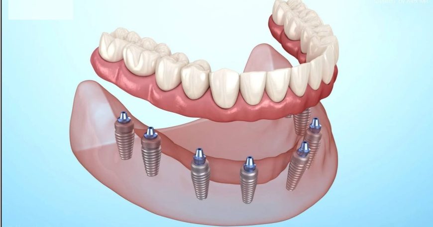 Best Dental Implants Treatment in Ahmedabad