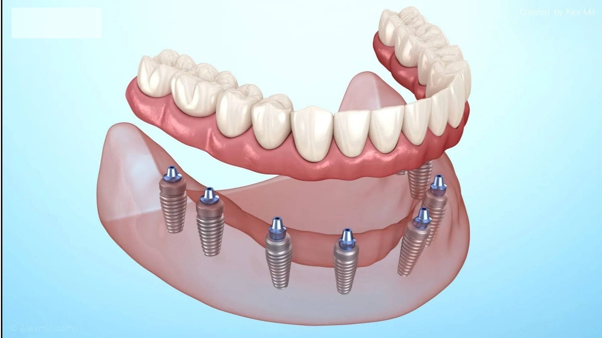 Best Dental Implants Treatment in Ahmedabad