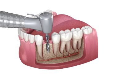 Best Root Canal Treatment in Ahmedabad