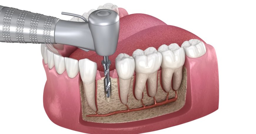 Best Root Canal Treatment in Ahmedabad