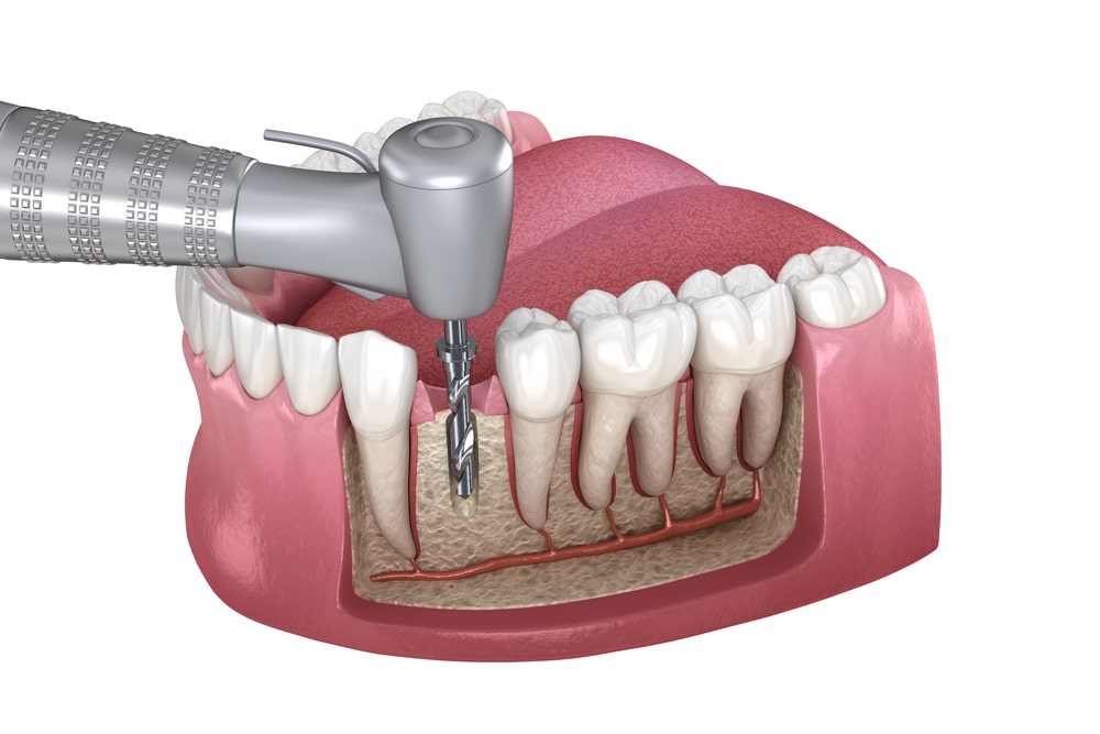 Best Root Canal Treatment in Ahmedabad