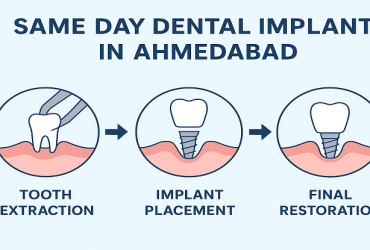 Same Day Dental Implants Ahmedabad