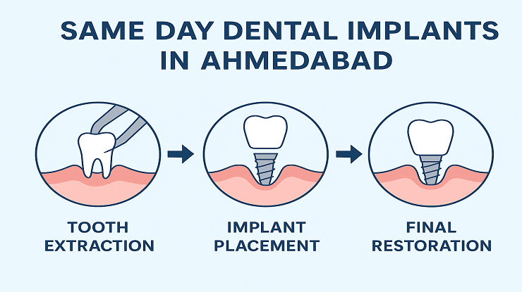 Same Day Dental Implants Ahmedabad